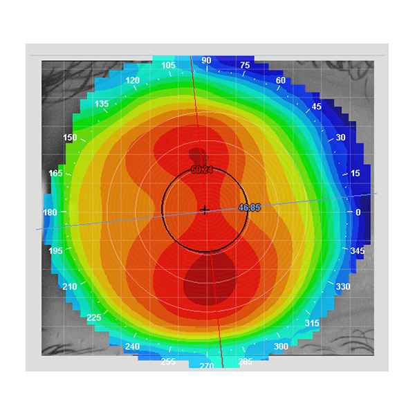 Corneal Mapping